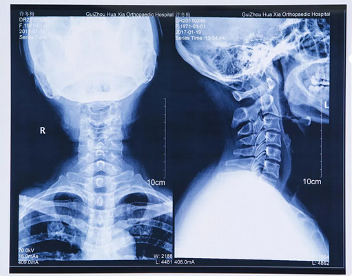 Blauwe laser medische droge sexy röntgen Bf film voor radiografisch onderzoek