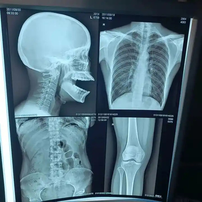 200±5 μM Dikte Medische röntgenfilm voor diagnostische hoge dichtheid
