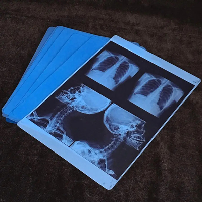 High Speed 8&quot;*10&quot; Blue PET Professional Inkjet Radiography Röntgenfilm Voor Printer